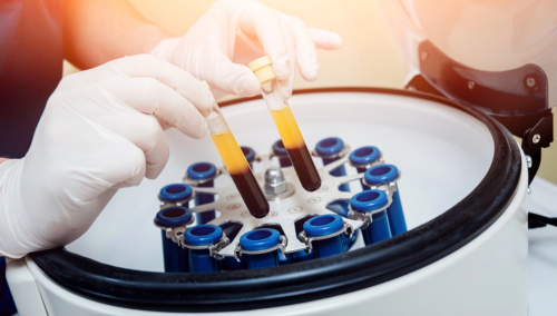 What Is PRP – Understanding Platelet-Rich Plasma